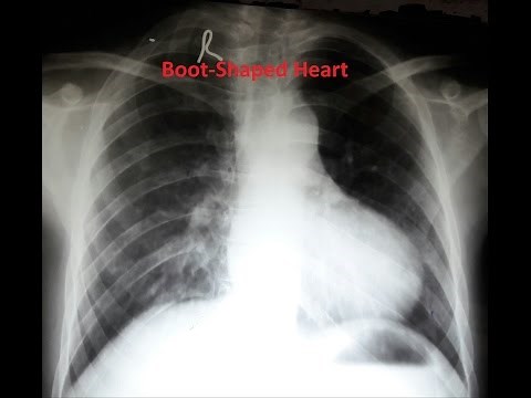 An Interesting Chest X-Ray | Tetralogy of Fallot | TOF | TOF X-Ray | Boot-Shaped Heart