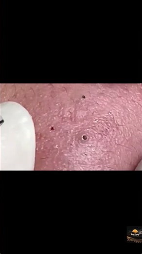 Best Acne Removal Treatment at Da Khoa Spa | Before & After Results #001