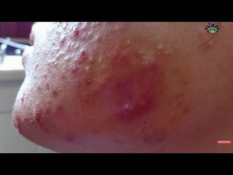 Satisfying Videos | Pimples Popping - Blackheads - Acne & Cysts Compilation #119