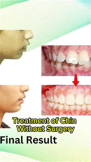 Ghani Dental Care on Instagram: "🦷 Orthodontics Can Change Faces… and Lives ✨ This patient presented with a short chin and a 13 mm increased overjet. With timely growth-modification treatment using a Twin Block appliance, followed by fixed braces, we were able to: ✔️ Correct jaw discrepancy ✔️ Reduce excessive overjet ✔️ Improve facial profile ✔️ Enhance smile and confidence This treatment did not just align teeth — it transformed her facial balance and quality of life. 👨‍⚕️ Dr. Muhammad Usman