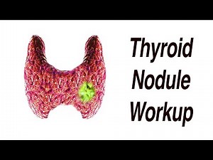 Thyroid Nodule Workup - What Happens Next? Is it Cancer?