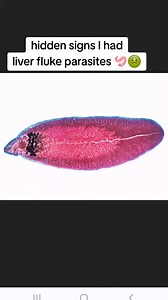 LIVER FLUKES: THEY ARE A THING 😭🪱 I would have never imagined that I would have liver fluke parasites, but after 6 months of detoxing yup I passed them. When you pass them they look like rolled up tomato skins. When they are alive they are flat and they attach to your liver. They can also clog up your bule ducts which can also lead to gallbladder issues. Note: the picture at the end is not my liver flukes I just found it online to show you all how they look when you pass them. I couldn't bring