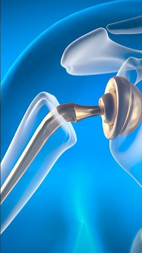 Reverse total shoulder replacement: How it works