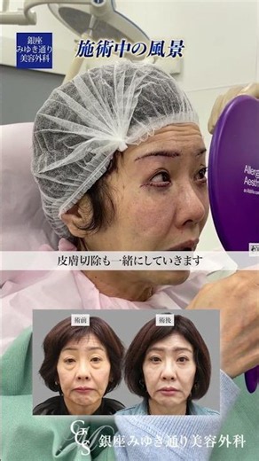 本編動画はこちらをタップ⬆️50代女性の目の下のクマたるみ治療 #クマ取り #美容整形