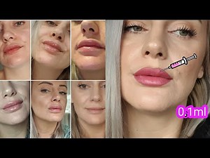Lip Fillers | My experience | Healing Process