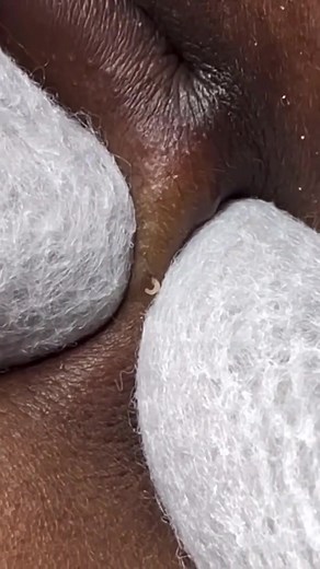 pimple remove on TikTok