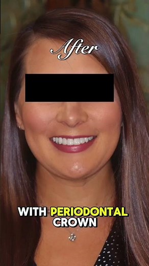 How to Fix a Gummy Smile