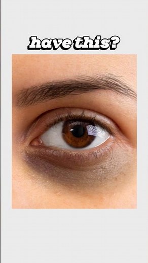 Homemade Dark Circles Remedy | DIY Eye Mask for Brighter Under Eyes #darkcircles #skincare #remedies