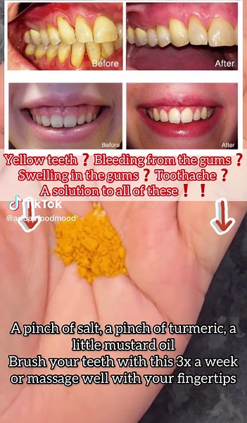 Natural Remedies for Oral Health: Turmeric, Salt, and Mustard Oil