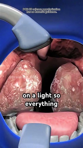 Tonsillectomy Procedure (3D Animation)