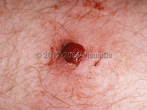 VisualDx - Lobular capillary hemangioma