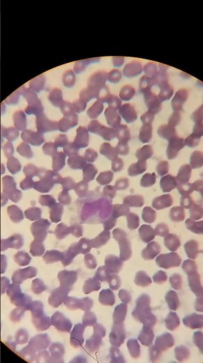 Monocytes Under the Microscope: The Body's Silent Guardians #hematology #microscope #whitebloodcell