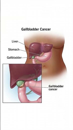 Can You Live Without a Gallbladder? Doctor Explains
