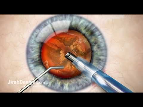 Phacoemulsification in Cataract Surgery [HD]