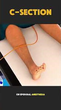 Cesarean Section Surgery Explained | C-Section Delivery Procedure & Recovery #medicaleducation