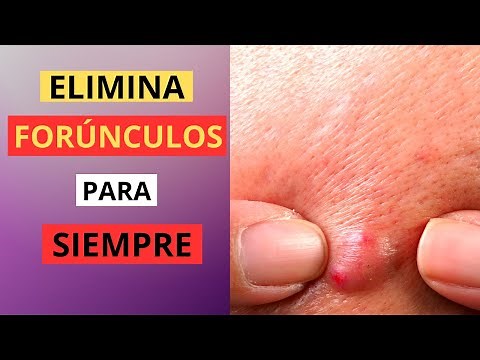 Consejos EFECTIVOS para COMBATIR los FORÚNCULOS de la PIEL