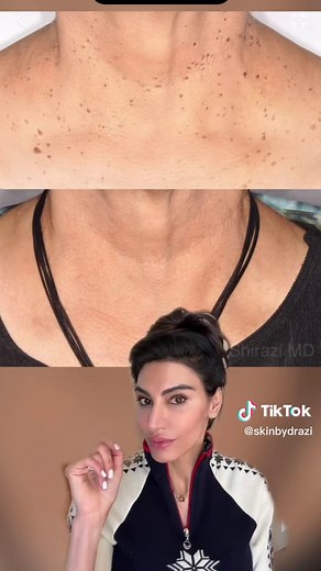 Understanding Seborrheic Keratosis: Causes and Treatments