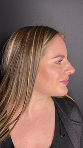 Facial rejuvenation and beautification with the use of dermal fillers