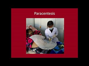 Long Term Pleural & Ascitic Drains