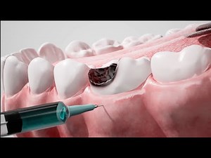 👉 Inside a Tooth Cavity: How Dentists Save Your Teeth Step by Step
