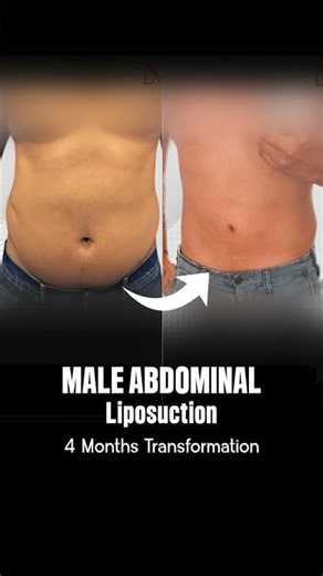 Male Abdomen Liposuction - 4 Months Transformation #shortsfeed