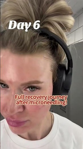Microneedling Recovery: A Complete Healing Diary 🧬✨
