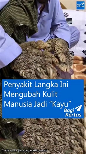 Bagi Kertas ID on Instagram: "Nama pria ini adalah Abdul Nasir Netuzahi, penderita kondisi kulit langka bernama Epidermodysplasia Verruciformis (EV) — atau yang sering dijuluki Tree Man Syndrome. EV adalah kelainan genetik sangat langka yang membuat tubuhnya tidak mampu melawan infeksi virus HPV (Human Papillomavirus) tertentu. Akibatnya, virus ini memicu pertumbuhan kulit berlebih yang membentuk tonjolan keras, tebal, dan berlapis seperti kulit pohon. Pertumbuhan itu disebut lesi kulit, yaitu b