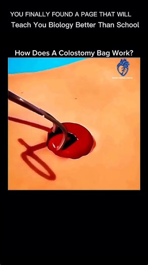 BIOLOGY | MEDICAL | HEALTH on Instagram: "🩺 How Does A Colostomy Bag Work? (The medical device that helps patients live normally) It may look intimidating, but a colostomy bag allows patients to pass waste safely when part of the colon isn’t functional 👀 🧠 Here’s how it works: • A surgical opening (stoma) is created in the abdomen • Waste from the intestine exits through the stoma into the bag • The bag collects stool and gas hygienically • Modern bags are discreet, odor-proof, and easy to ma