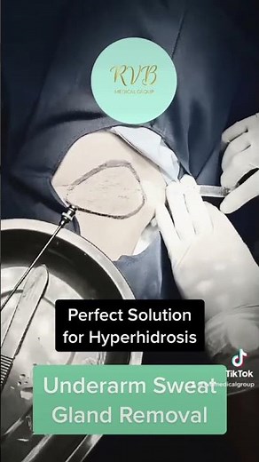 Underarm Sweat Gland Removal