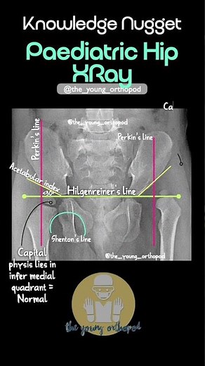 DDH X-ray Explained in 60 Seconds 🔥 | Hilgenreiner, Perkin, Shenton & Acetabular Index Made Easy