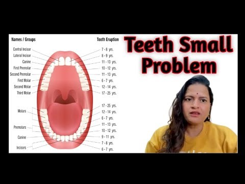 Front capping ￼of 🦷