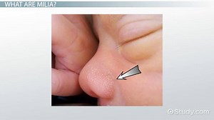 Milia | Definition, Causes & Treatment