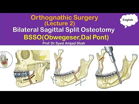 Obwegeser | Dal Pont | BSSO | Bilateral Sagittal Split Osteotomy | Orthognathic Surgery