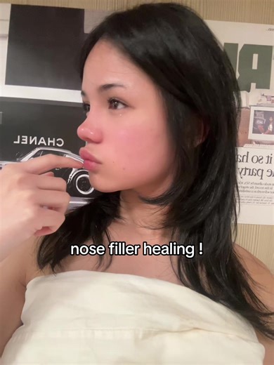 Nose Filler Healing Process: Swollen but Looks Good!
