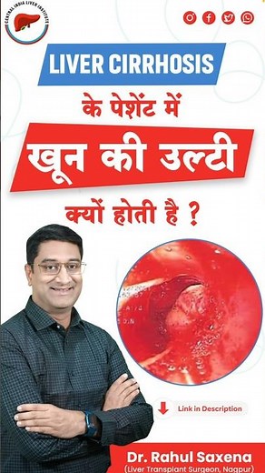 Why does a liver cirrhosis patient vomit blood? | Dr. Rahul Saxena | #livercirrhosis #liverpool