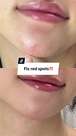 Effective Micro-Dart Patch for Clear Skin