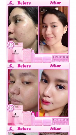 Before and After: PerfectSkin Rejuvenating Set for Flawless Skin