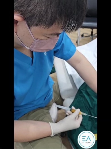 🚨【髋关节疼痛救星】超声引导PRP注射，告别骨关节炎！👨⚕️ 📌 **什么是PRP治疗？** 👉 提取自体血液中的高浓度血小板，注入关节，促进修复！ 💡 **原理**：血小板释放生长因子，加速软骨再生，减少炎症！ 🎯 **适用人群** - 早期/中期髋关节骨关节炎 - 传统治疗无效、不想手术的你！ 🌟 **超声引导的优势** ✅ 精准定位：实时影像，直达病灶！ ✅ 安全微创：避开神经血管，恢复快！ ✅ 效果加倍：疗效提升，疼痛bye bye！ ⏱️ **过程超快**：抽血 注射，30分钟搞定！ 🌱 **术后注意**：避免负重，遵医嘱复健哦～ 💬 **你的髋关节还好吗？** 👇 留言分享你的抗痛经历，或咨询专业建议！ 🔔 **关注我，get更多骨科黑科技！** #髋关节骨关节炎 #PRP治疗 #超声引导 #骨科健康 #疼痛管理 #医疗科技 **⚠️ 提示**：效果因人而异，请务必咨询专业医师哦！👩⚕️📋