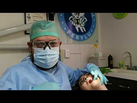 Extracción dental superior