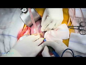 How Prof. Ünal Aydın Do It: No-Touch Posterior Hepatectomy & Diaphragmatic Peritoneum