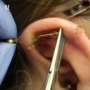 This woman didn't look after her scaffolding piercing and had to get it professionaly removed and cleaned👂 | Ultimate