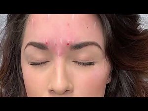 Allergan - Botox Treatment