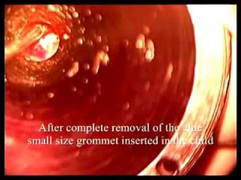 Myringotomy & Grommet Insertion for otitis media with effusion (OME) - Glue Ear