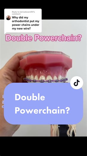 Double Powerchain Braces: Closing Stubborn Spaces