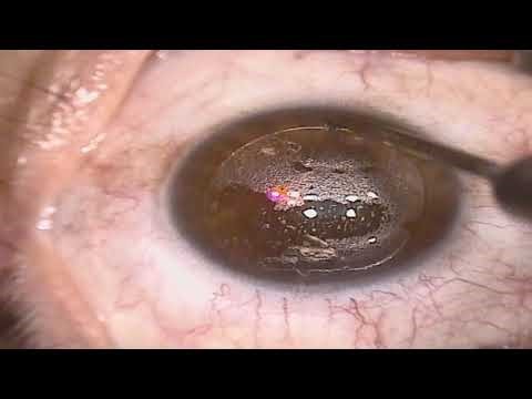 LASIK Procedure to Fix Astigmatism and Stop Using Readers