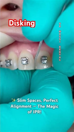 ✨ Slim Spaces, Perfect Alignment — The Magic of IPR!