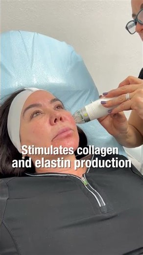 ✅MICRODERMA RF: How This Med Spa Facial Machine Works