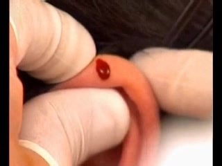 耳尖放血治疗高血压技术