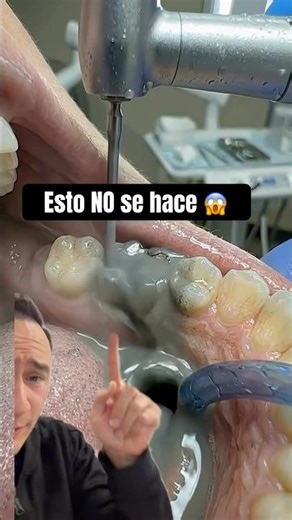 The worst way to remove a dental amalgam filling