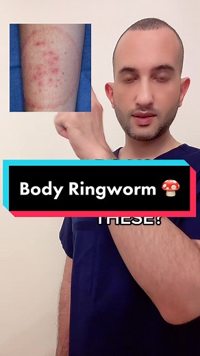 #Ringworm is a common and contagious #fungal skin infection that gets its name from the red, itchy, ring-shaped skin #rash it causes. It spreads quite easily through direct contact.